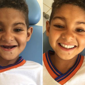‘Agora eu posso rir porque tenho meus dentes’, diz menino que teve sonho realizado por dentista quase 5 anos após tratamento