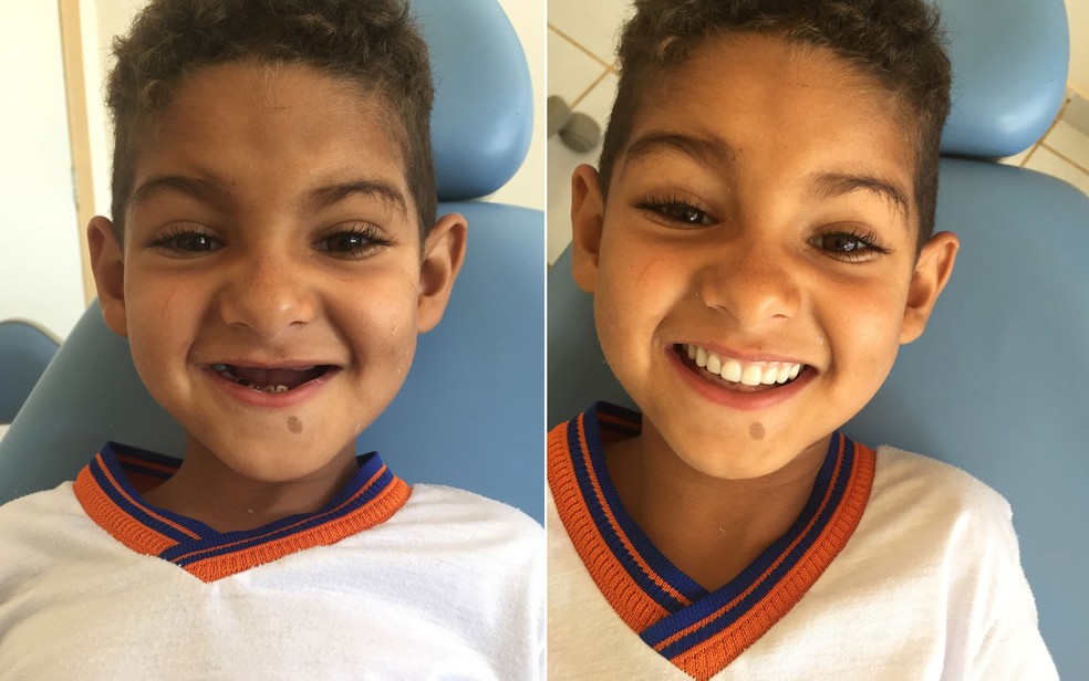 ‘Agora eu posso rir porque tenho meus dentes’, diz menino que teve sonho realizado por dentista quase 5 anos após tratamento