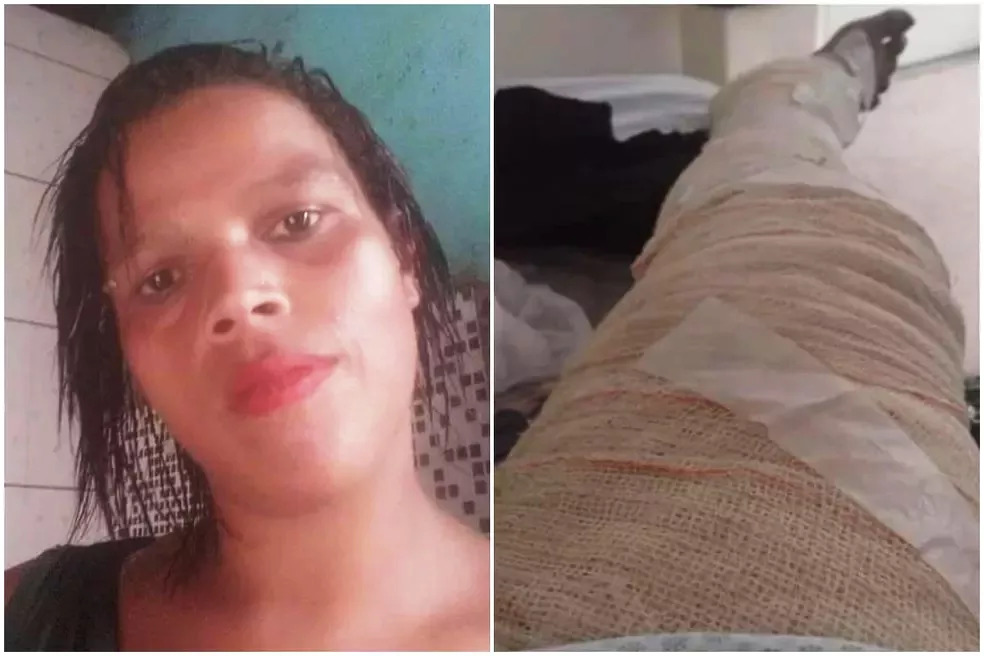 Jovem que não tinha dinheiro para gás morre após queimar 85% do corpo com álcool