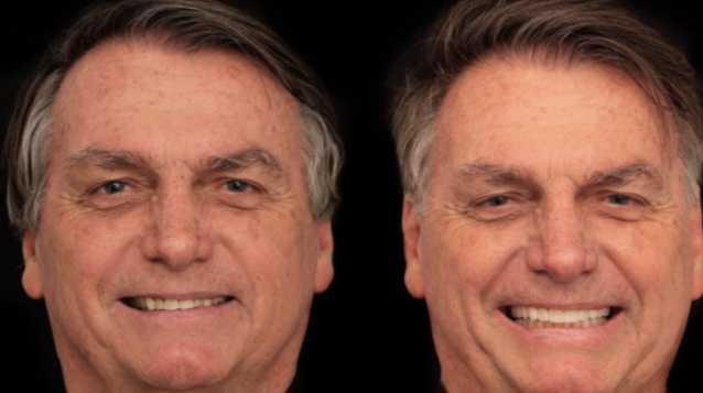 Bolsonaro faz harmonização facial e gasta R$ 3 mil em cada dente