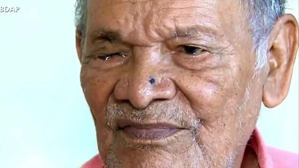 Sete pessoas ficam cegas após contaminação por fungo em mutirão de cirurgias de catarata